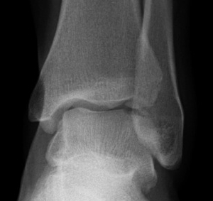 Talus OCD Anterolateral Fragment